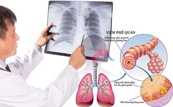 Review top 3 miếng dán chữa viêm phế quản hiệu quả nhất